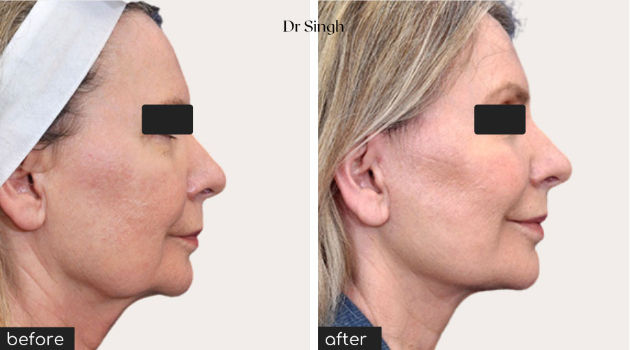 before after mini face lift nyc